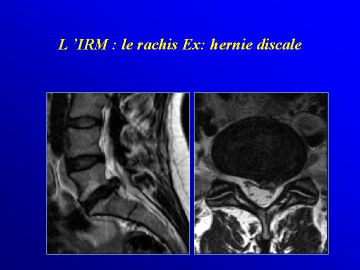 L ’IRM : le rachis Ex: hernie discale 