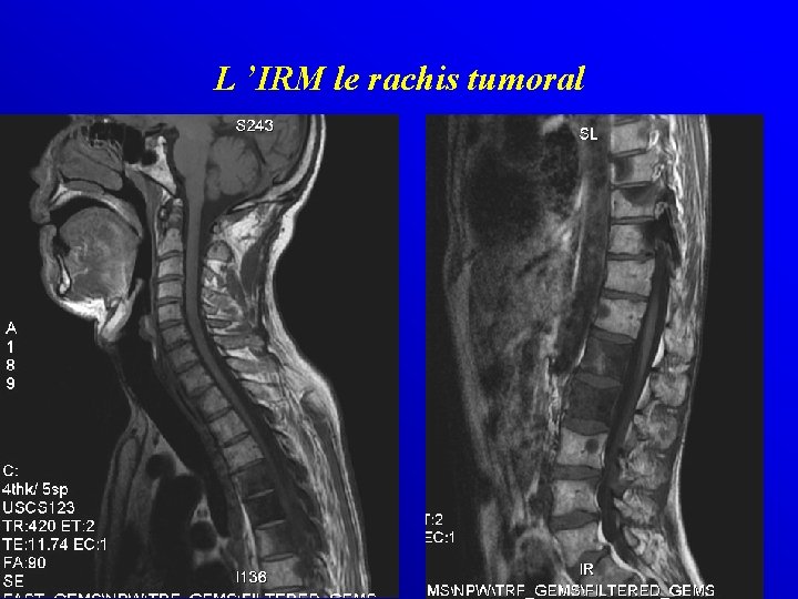 L ’IRM le rachis tumoral 