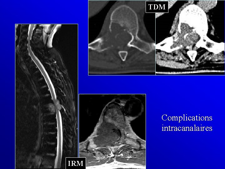 TDM Complications intracanalaires IRM 