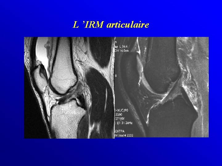 L ’IRM articulaire 