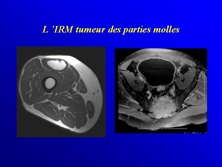 L ’IRM tumeur des parties molles 