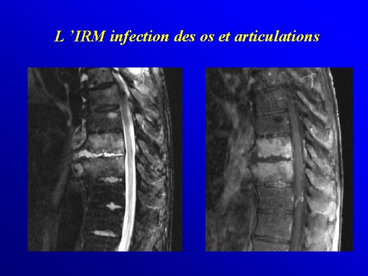 L ’IRM infection des os et articulations 