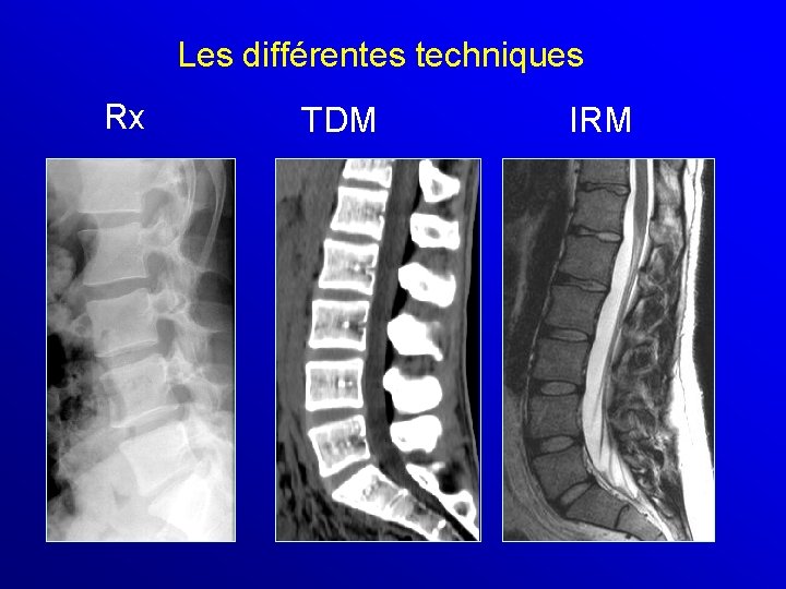 Les différentes techniques Rx TDM IRM 