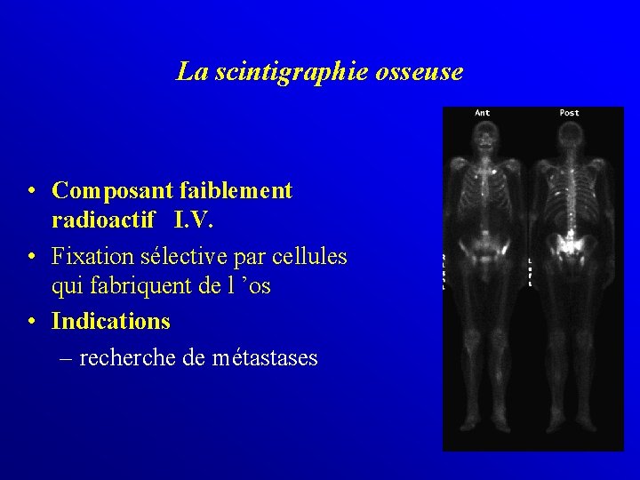 La scintigraphie osseuse • Composant faiblement radioactif I. V. • Fixation sélective par cellules