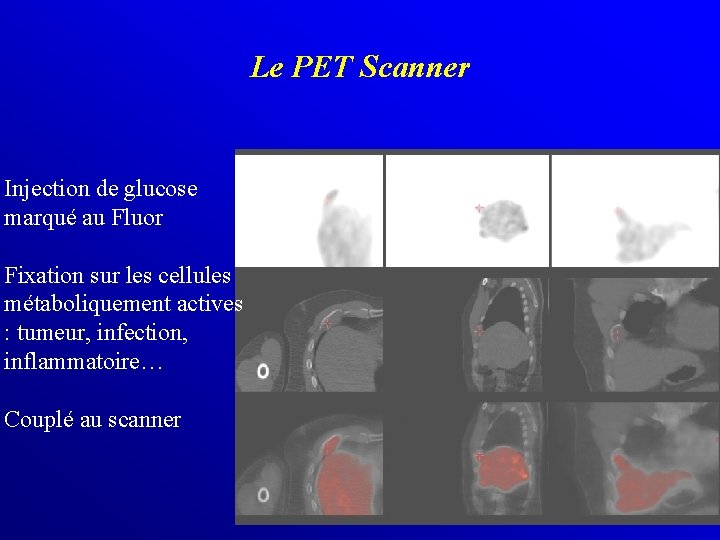 Le PET Scanner Injection de glucose marqué au Fluor Fixation sur les cellules métaboliquement