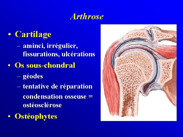 Arthrose • Cartilage – aminci, irrégulier, fissurations, ulcérations • Os sous-chondral – géodes –