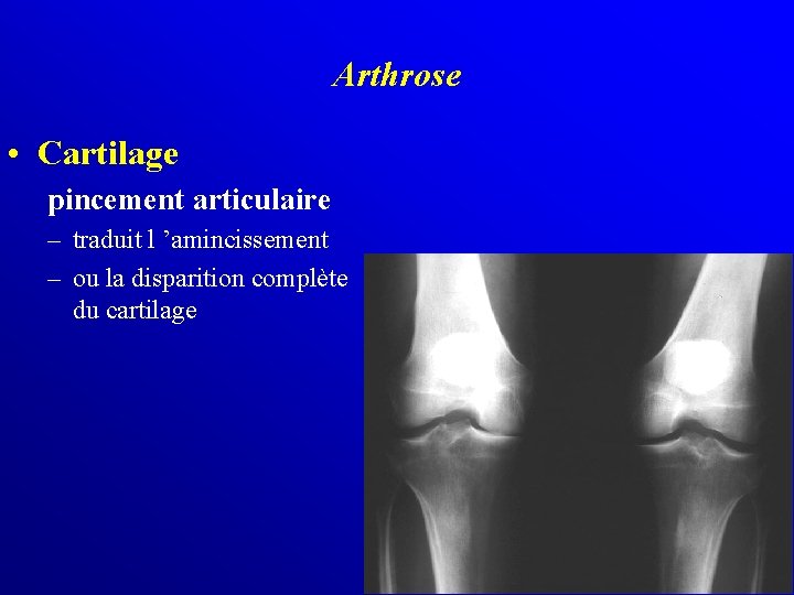 Arthrose • Cartilage pincement articulaire – traduit l ’amincissement – ou la disparition complète