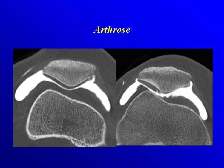 Arthrose 