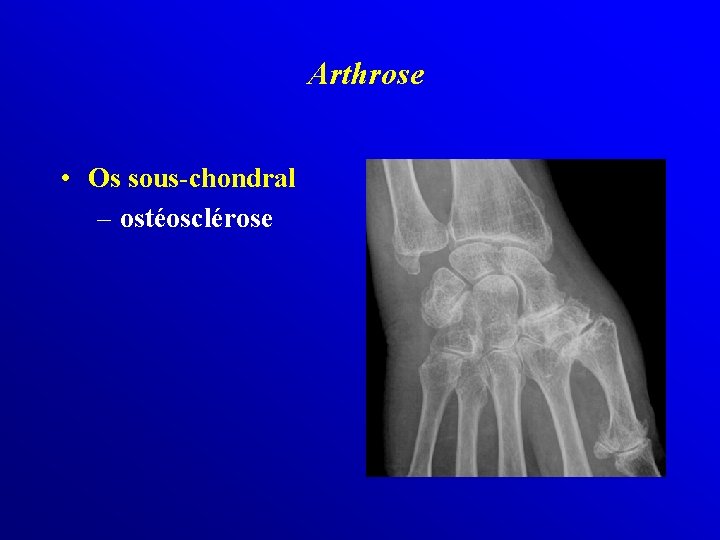 Arthrose • Os sous-chondral – ostéosclérose 