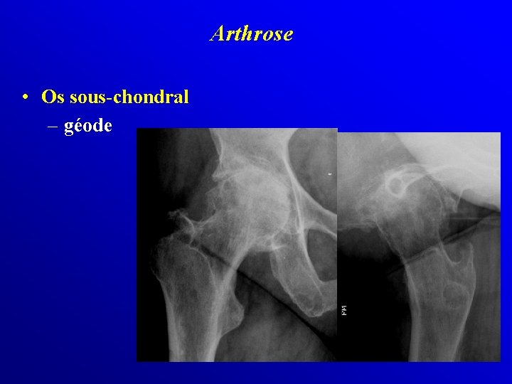 Arthrose • Os sous-chondral – géode 