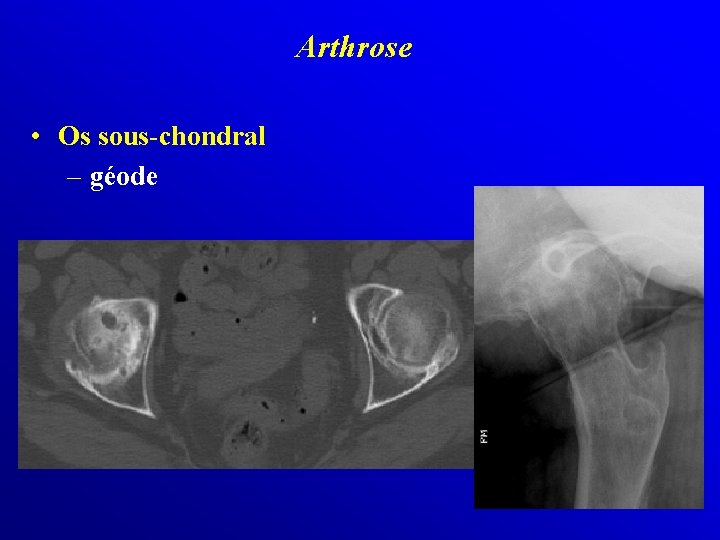 Arthrose • Os sous-chondral – géode 
