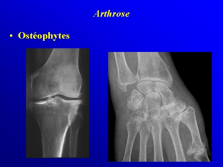 Arthrose • Ostéophytes 