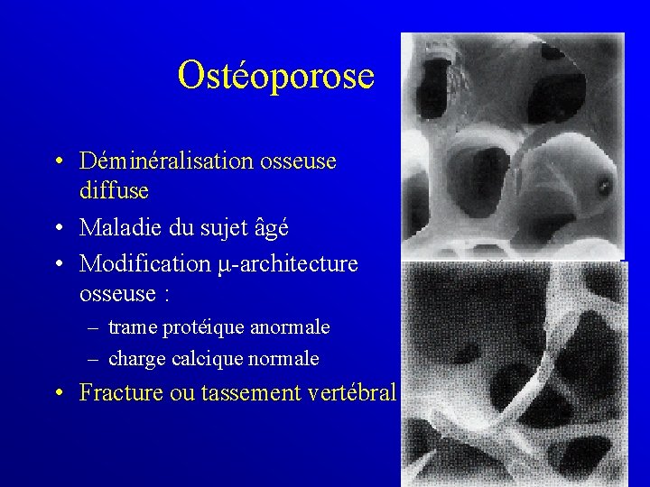 Ostéoporose • Déminéralisation osseuse diffuse • Maladie du sujet âgé • Modification μ-architecture osseuse