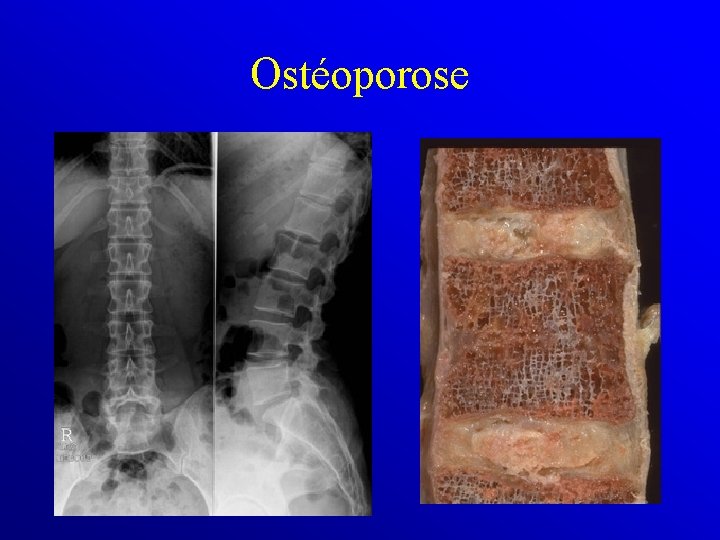 Ostéoporose 