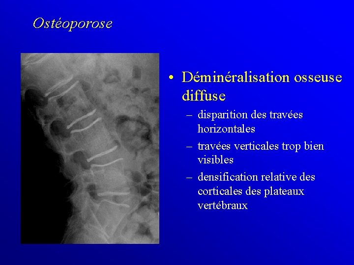 Ostéoporose • Déminéralisation osseuse diffuse – disparition des travées horizontales – travées verticales trop
