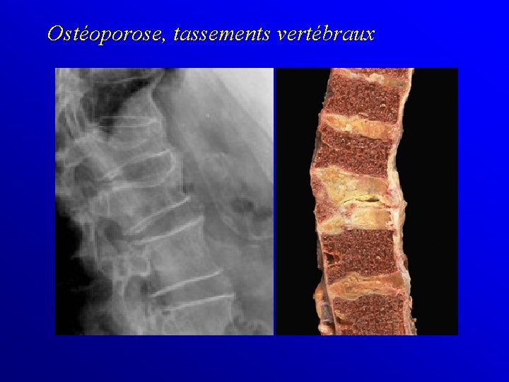 Ostéoporose, tassements vertébraux 