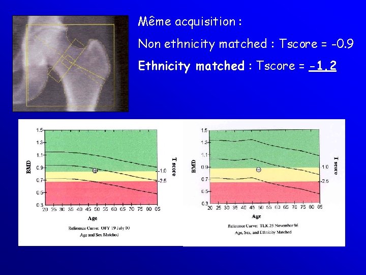 Même acquisition : Non ethnicity matched : Tscore = -0. 9 Ethnicity matched :