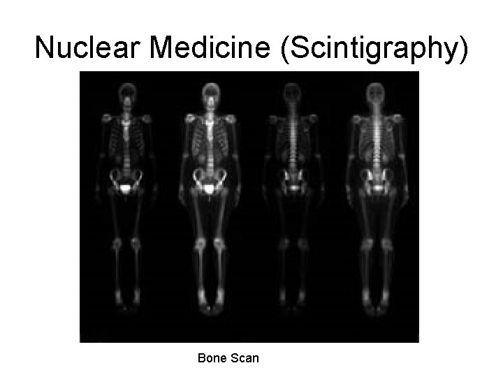 Nuclear Medicine (Scintigraphy) Bone Scan 