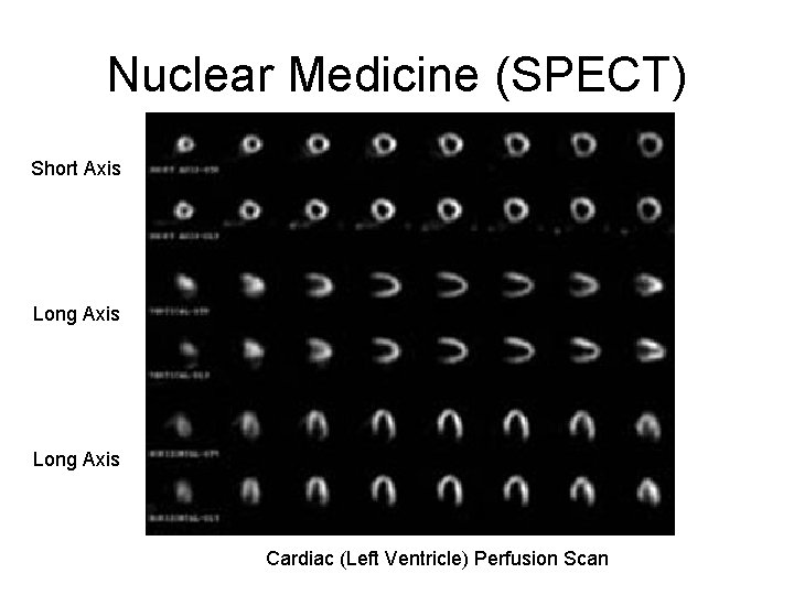 Nuclear Medicine (SPECT) Short Axis Long Axis Cardiac (Left Ventricle) Perfusion Scan 