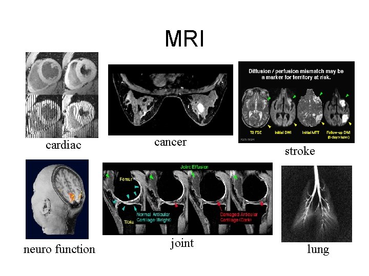 MRI cardiac neuro function cancer joint stroke lung 