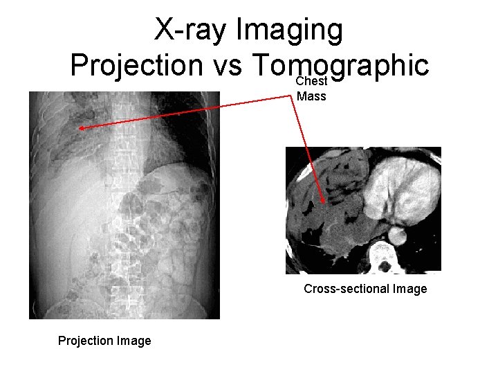X-ray Imaging Projection vs Tomographic Chest Mass Cross-sectional Image Projection Image 