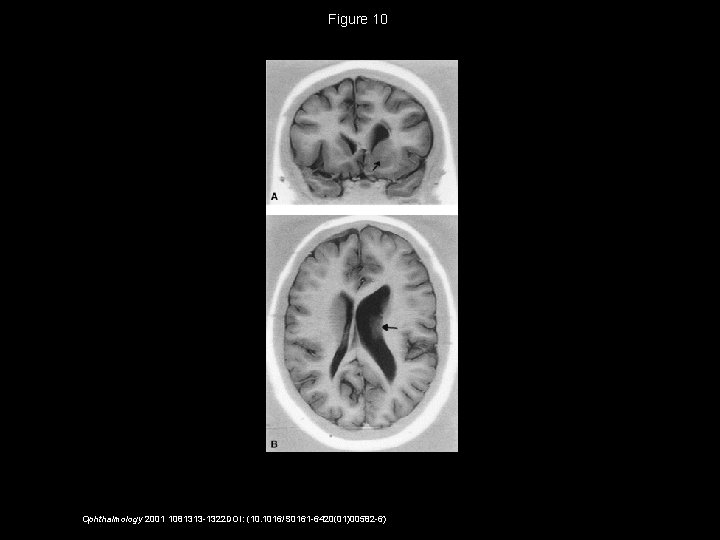 Figure 10 Ophthalmology 2001 1081313 -1322 DOI: (10. 1016/S 0161 -6420(01)00582 -6) 