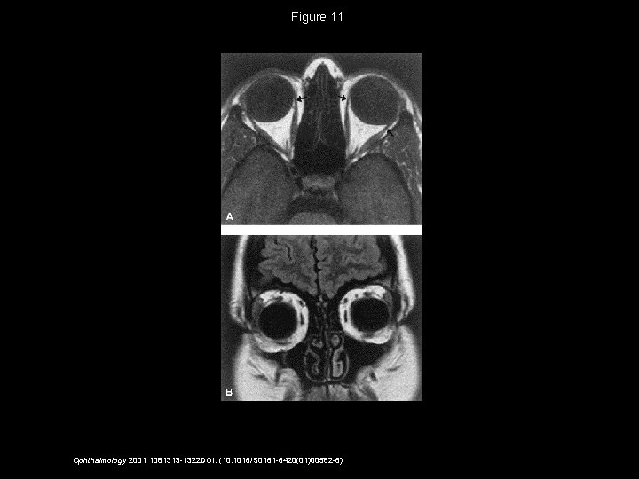 Figure 11 Ophthalmology 2001 1081313 -1322 DOI: (10. 1016/S 0161 -6420(01)00582 -6) 