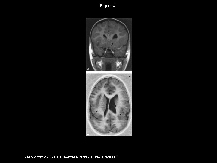 Figure 4 Ophthalmology 2001 1081313 -1322 DOI: (10. 1016/S 0161 -6420(01)00582 -6) 