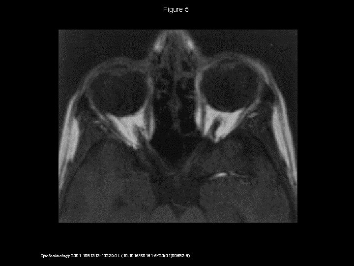 Figure 5 Ophthalmology 2001 1081313 -1322 DOI: (10. 1016/S 0161 -6420(01)00582 -6) 