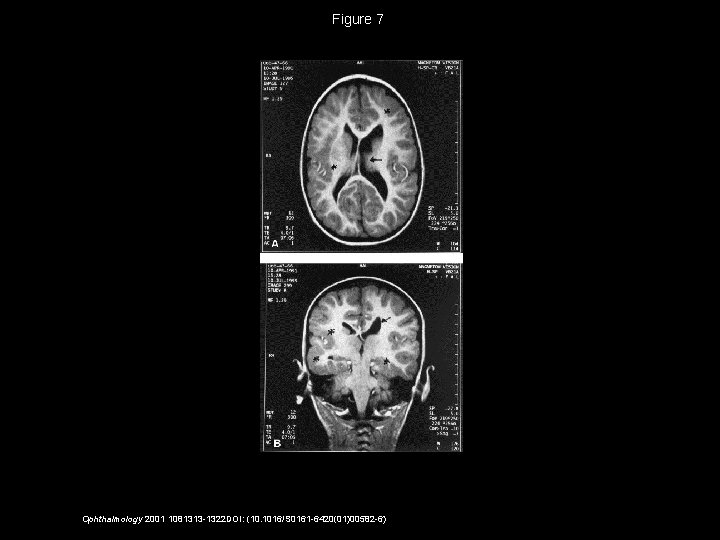 Figure 7 Ophthalmology 2001 1081313 -1322 DOI: (10. 1016/S 0161 -6420(01)00582 -6) 