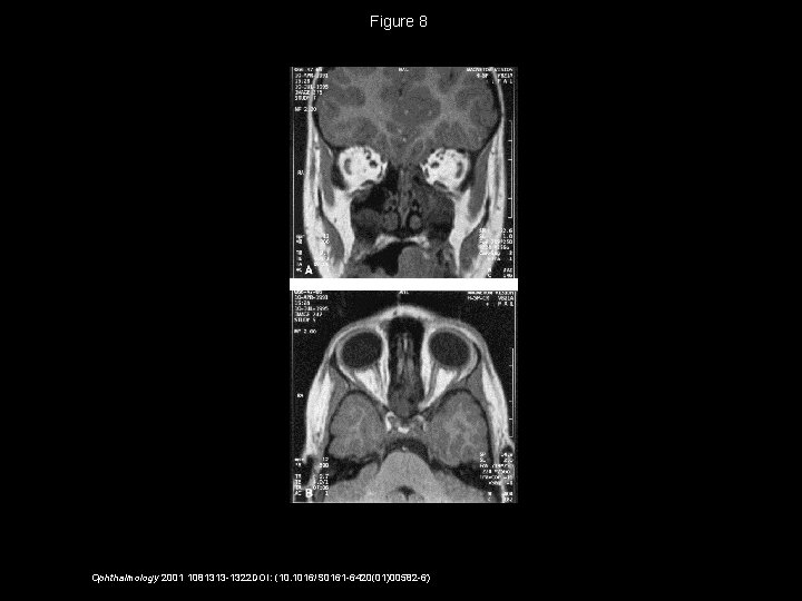 Figure 8 Ophthalmology 2001 1081313 -1322 DOI: (10. 1016/S 0161 -6420(01)00582 -6) 