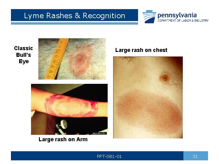 Lyme Rashes & Recognition Classic Bull’s Eye Large rash on chest Large rash on