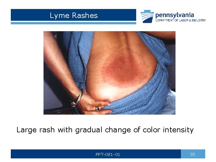 Lyme Rashes Large rash with gradual change of color intensity PPT-081 -01 35 
