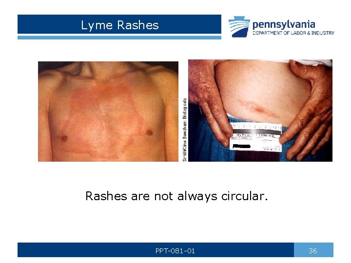 Lyme Rashes are not always circular. PPT-081 -01 36 