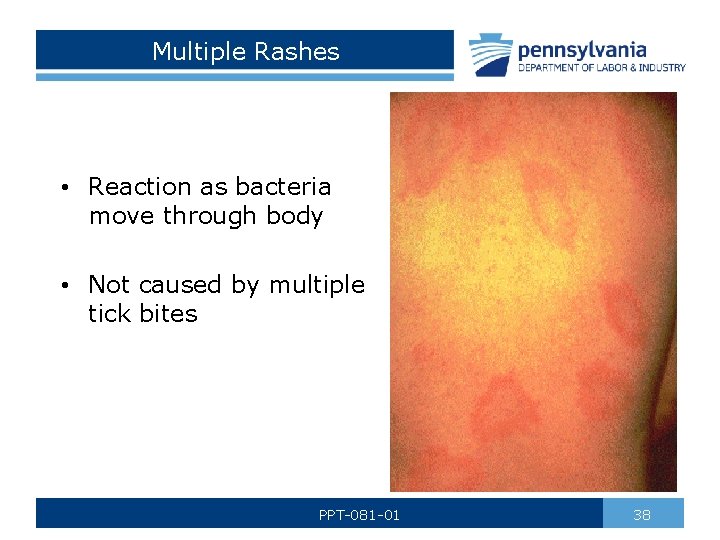 Multiple Rashes • Reaction as bacteria move through body • Not caused by multiple