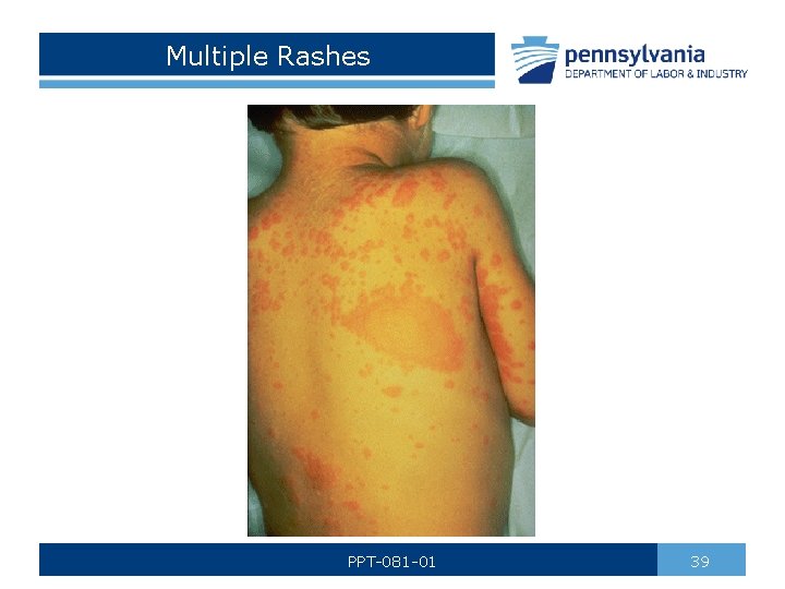 Multiple Rashes PPT-081 -01 39 