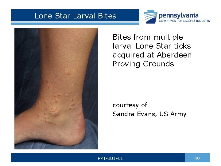 Lone Star Larval Bites from multiple larval Lone Star ticks acquired at Aberdeen Proving