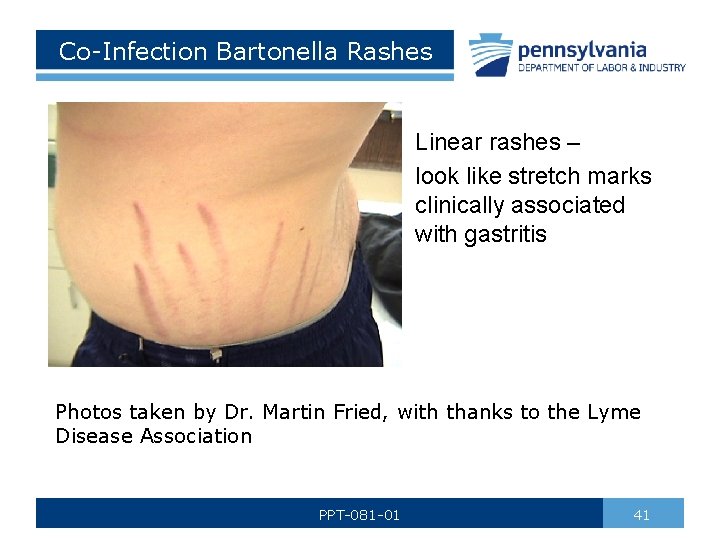 Co-Infection Bartonella Rashes Linear rashes – look like stretch marks clinically associated with gastritis
