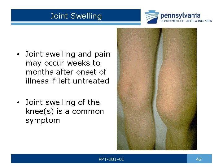 Joint Swelling • Joint swelling and pain may occur weeks to months after onset