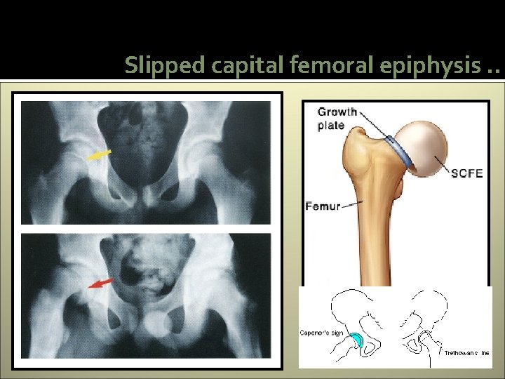 Slipped capital femoral epiphysis. . 