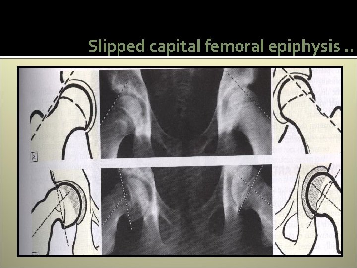 Slipped capital femoral epiphysis. . 