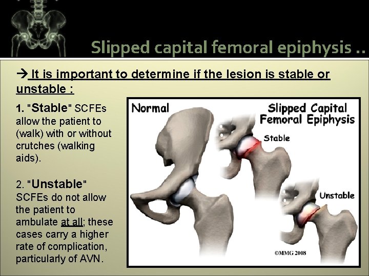 Slipped capital femoral epiphysis. . It is important to determine if the lesion is