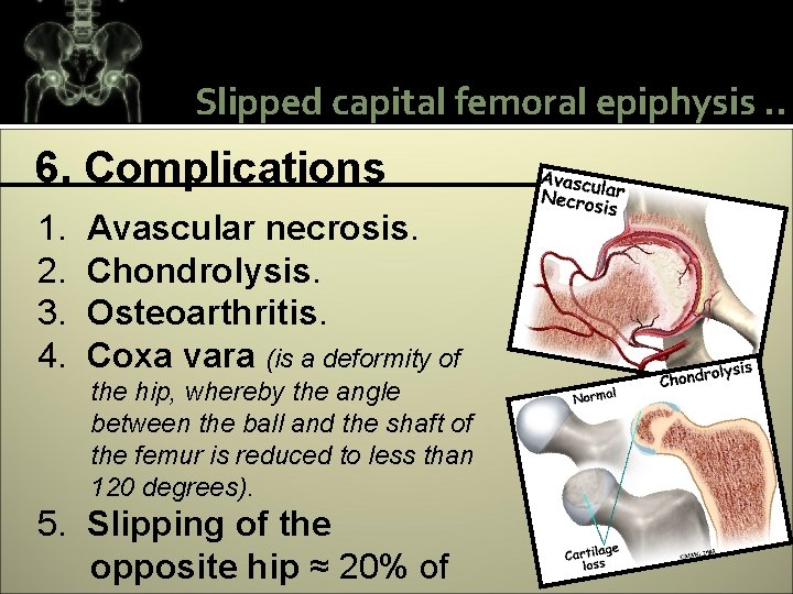 Slipped capital femoral epiphysis. . 6. Complications 1. 2. 3. 4. Avascular necrosis. Chondrolysis.