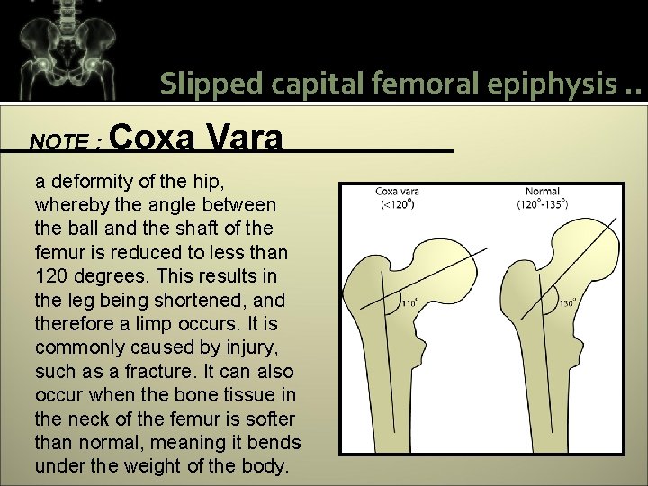 Slipped capital femoral epiphysis. . NOTE : Coxa Vara a deformity of the hip,