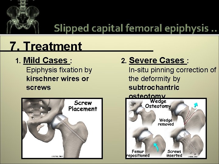 Slipped capital femoral epiphysis. . 7. Treatment 1. Mild Cases : Epiphysis fixation by