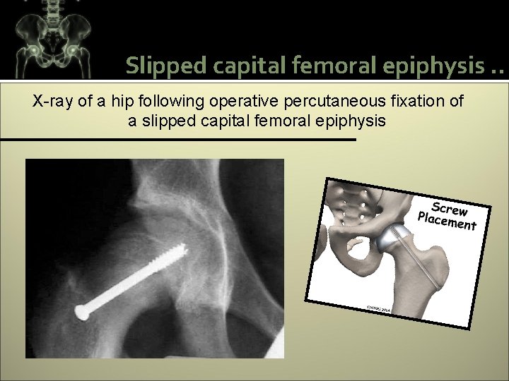 Slipped capital femoral epiphysis. . X-ray of a hip following operative percutaneous fixation of