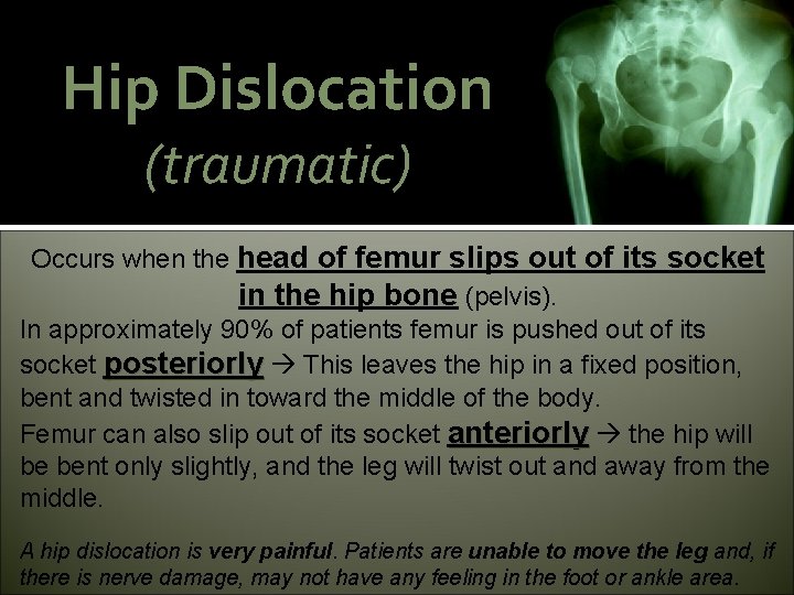 Hip Dislocation (traumatic) Occurs when the head of femur slips out of its socket