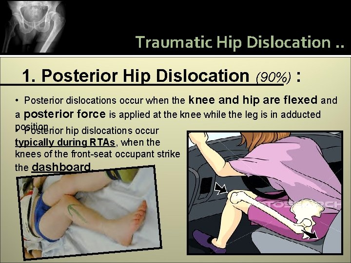 Traumatic Hip Dislocation. . 1. Posterior Hip Dislocation (90%) : • Posterior dislocations occur