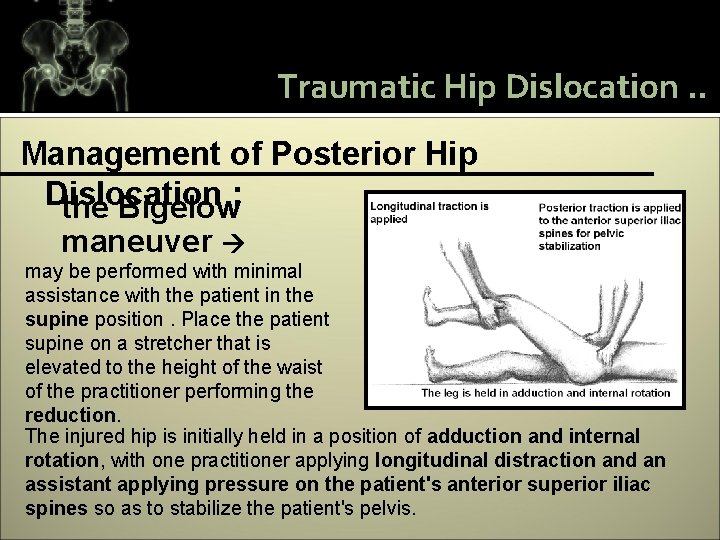 Traumatic Hip Dislocation. . Management of Posterior Hip Dislocation the Bigelow: maneuver may be