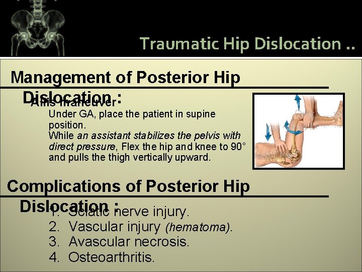 Traumatic Hip Dislocation. . Management of Posterior Hip Dislocation Allis maneuver: Under GA, place